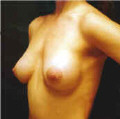 Silicone artificial breast size 275